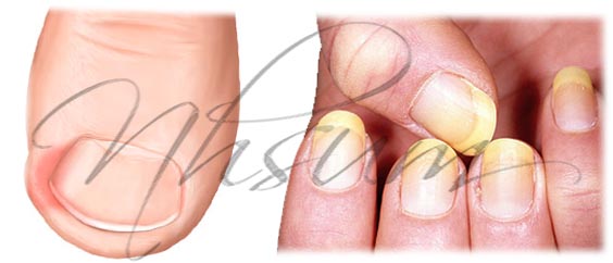 Como comienza el hongo sobre las uñas de la mano